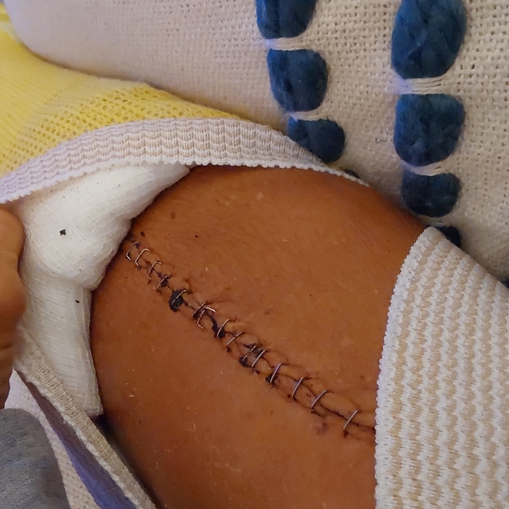 Staples on both sides